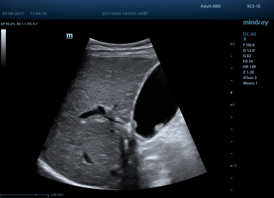 Mindray DC-80 X-Insight